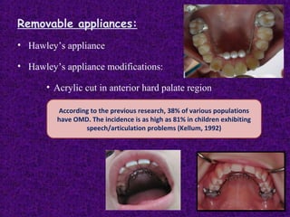 Removable appliances:
• Hawley’s appliance
• Hawley’s appliance modifications:
• Acrylic cut in anterior hard palate region
• Cribs or rakes employed in anterior partAccording to the previous research, 38% of various populations
have OMD. The incidence is as high as 81% in children exhibiting
speech/articulation problems (Kellum, 1992)
 