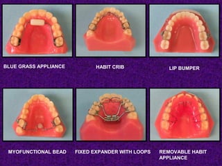 BLUE GRASS APPLIANCE HABIT CRIB LIP BUMPER
MYOFUNCTIONAL BEAD FIXED EXPANDER WITH LOOPS REMOVABLE HABIT
APPLIANCE
 
