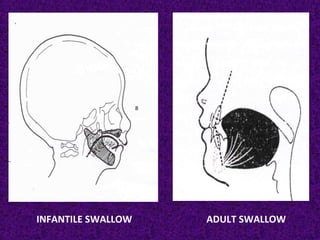 INFANTILE SWALLOW ADULT SWALLOW
 