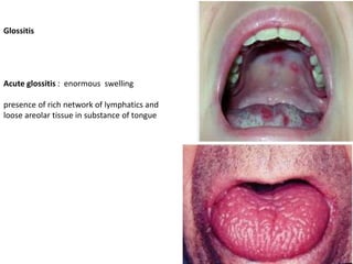 Glossitis
Acute glossitis : enormous swelling
presence of rich network of lymphatics and
loose areolar tissue in substance of tongue
 