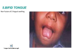 Non fusion of 2 lingual swelling
 