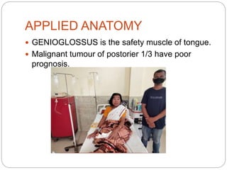  GENIOGLOSSUS is the safety muscle of tongue.
 Malignant tumour of postorier 1/3 have poor
prognosis.
APPLIED ANATOMY
 