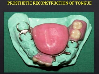 PROSTHETIC RECONSTRUCTION OF TONGUE
 