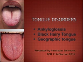 Presented by Anastasiya Smirnova
DEN 1114/Section 8216
 Ankyloglossia
 Black Hairy Tongue
 Geographic tongue
 