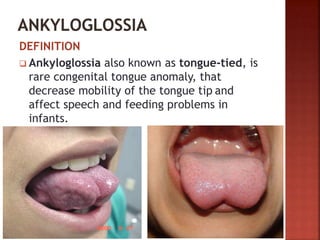DEFINITION
 Ankyloglossia also known as tongue-tied, is
rare congenital tongue anomaly, that
decrease mobility of the tongue tip and
affect speech and feeding problems in
infants.
 