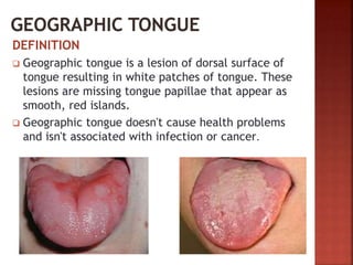 DEFINITION
 Geographic tongue is a lesion of dorsal surface of
tongue resulting in white patches of tongue. These
lesions are missing tongue papillae that appear as
smooth, red islands.
 Geographic tongue doesn't cause health problems
and isn't associated with infection or cancer.
 