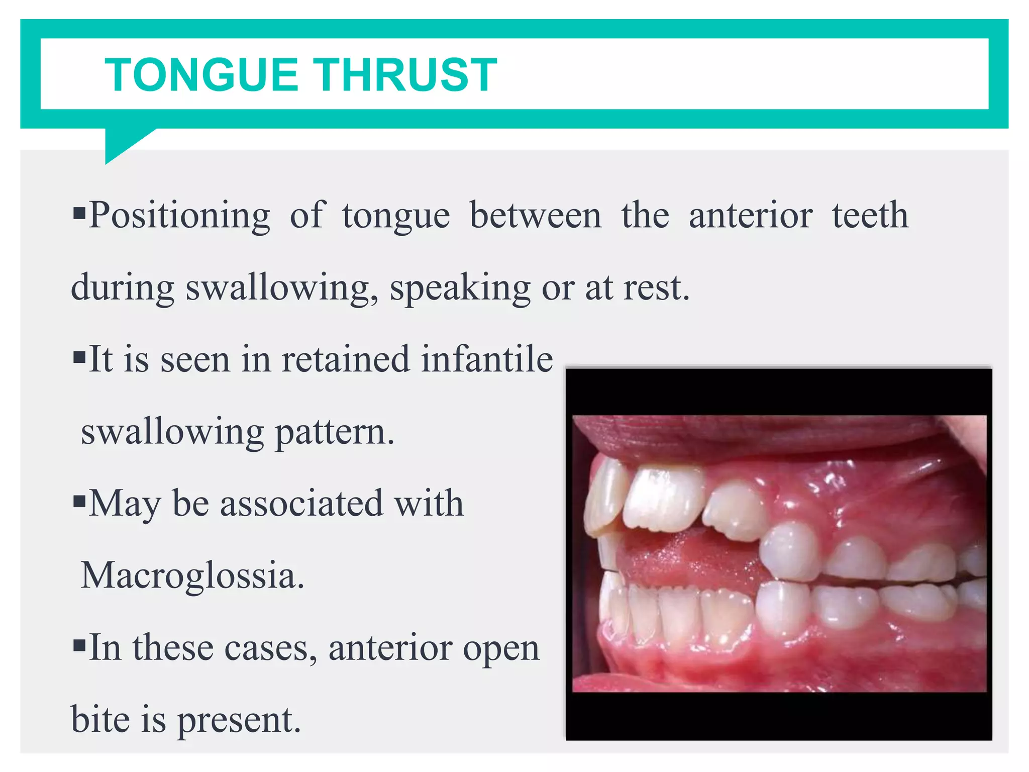 TONGUE THRUST
Positioning of tongue between the anterior teeth
during swallowing, speaking or at rest.
It is seen in retained infantile
swallowing pattern.
May be associated with
Macroglossia.
In these cases, anterior open
bite is present.
 