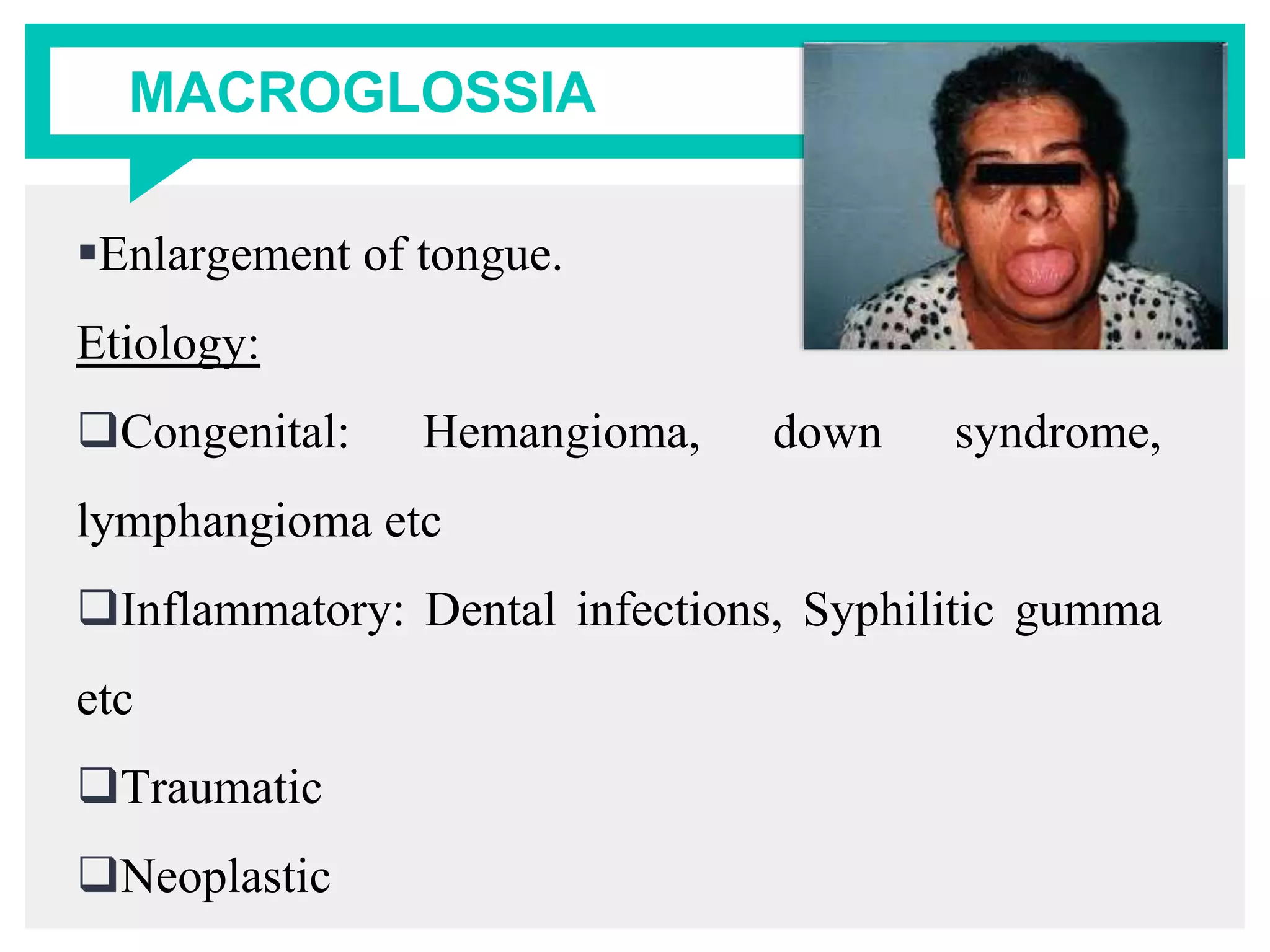 MACROGLOSSIA
Enlargement of tongue.
Etiology:
Congenital: Hemangioma, down syndrome,
lymphangioma etc
Inflammatory: Dental infections, Syphilitic gumma
etc
Traumatic
Neoplastic
 