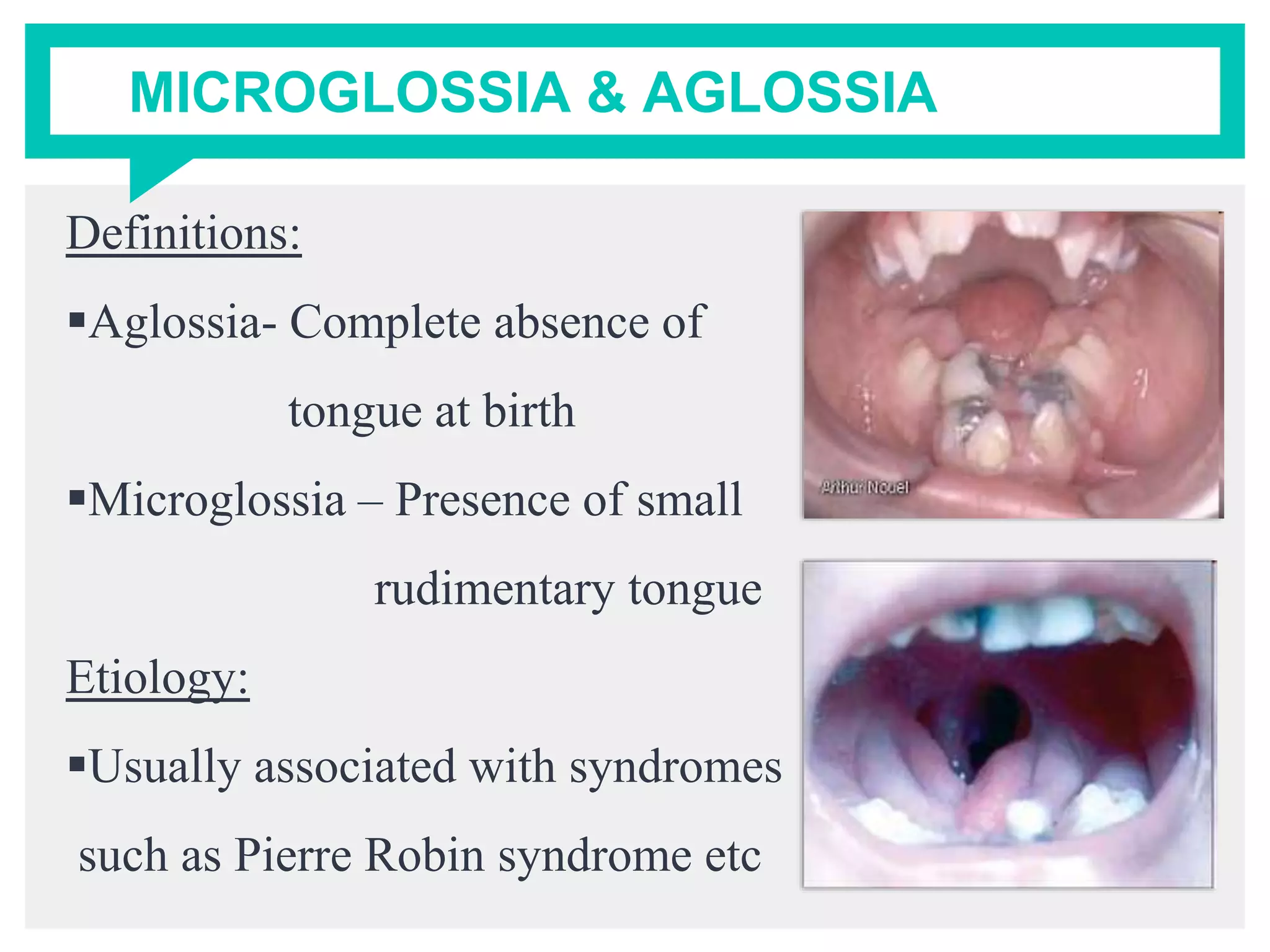 MICROGLOSSIA & AGLOSSIA
Definitions:
Aglossia- Complete absence of
tongue at birth
Microglossia – Presence of small
rudimentary tongue
Etiology:
Usually associated with syndromes
such as Pierre Robin syndrome etc
 