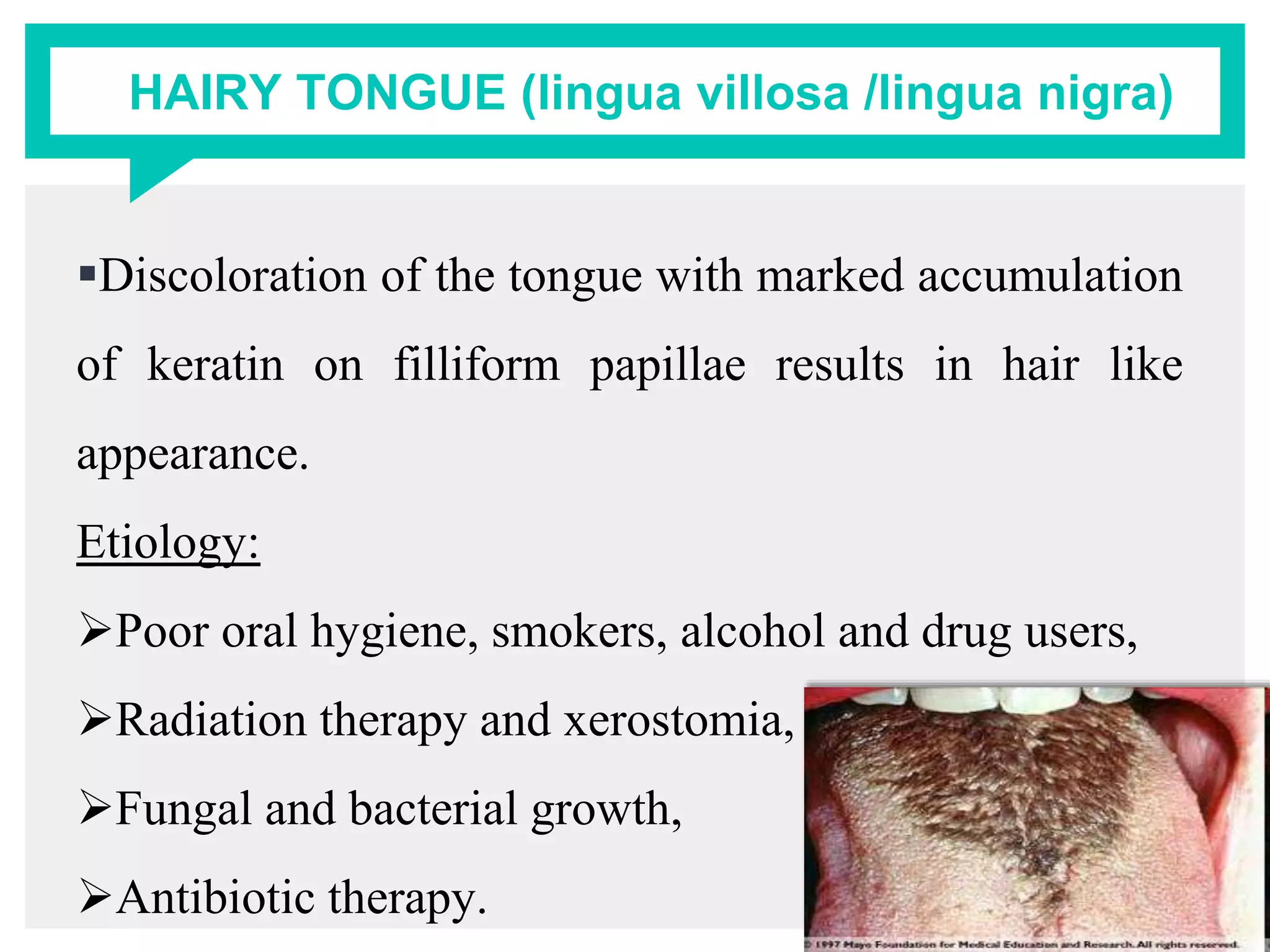 HAIRY TONGUE (lingua villosa /lingua nigra)
Discoloration of the tongue with marked accumulation
of keratin on filliform papillae results in hair like
appearance.
Etiology:
Poor oral hygiene, smokers, alcohol and drug users,
Radiation therapy and xerostomia,
Fungal and bacterial growth,
Antibiotic therapy.
 