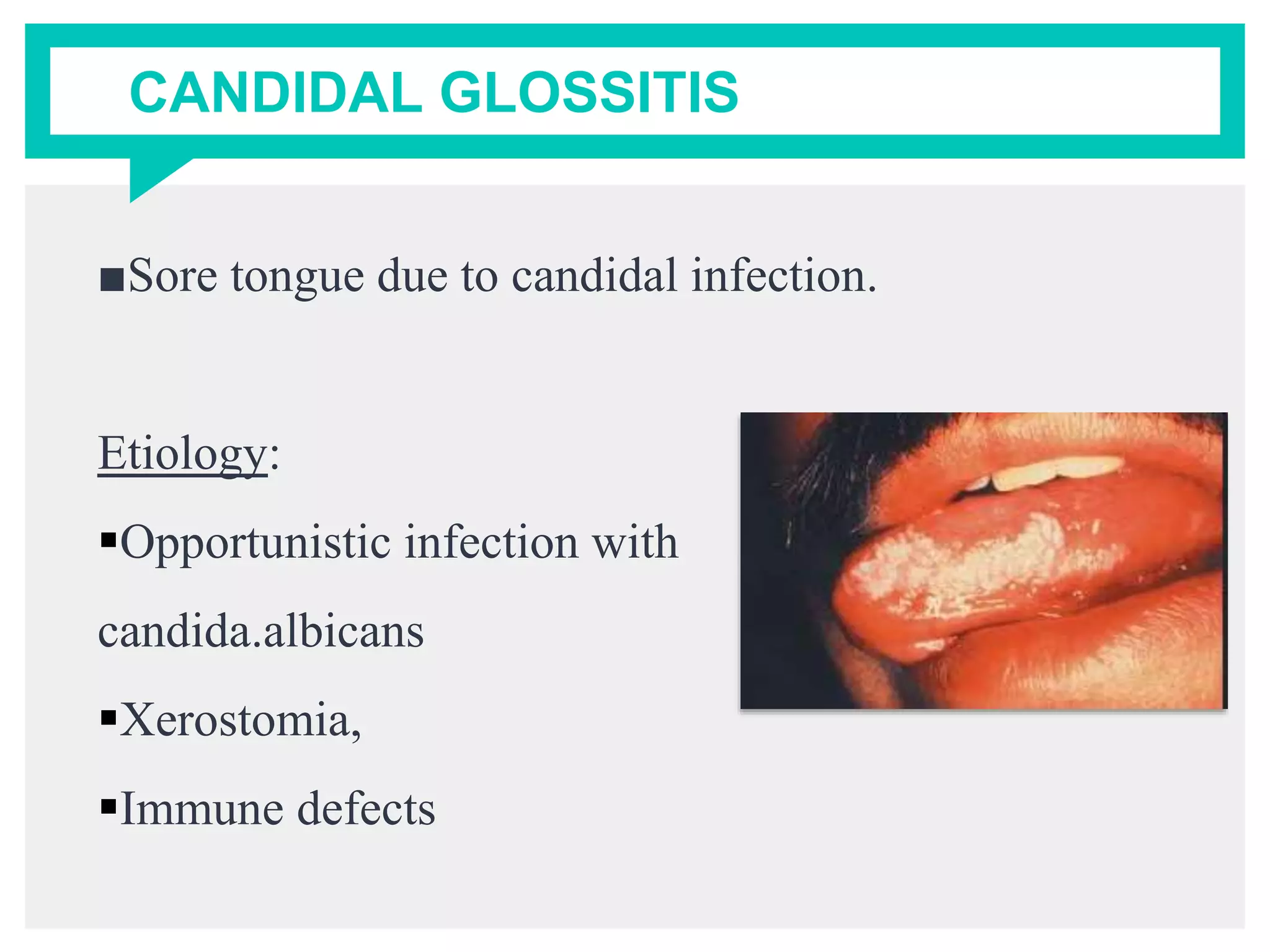 CANDIDAL GLOSSITIS
■Sore tongue due to candidal infection.
Etiology:
Opportunistic infection with
candida.albicans
Xerostomia,
Immune defects
 