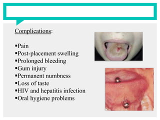Complications:
Pain
Post-placement swelling
Prolonged bleeding
Gum injury
Permanent numbness
Loss of taste
HIV and hepatitis infection
Oral hygiene problems
 