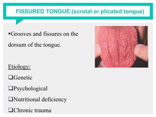 FISSURED TONGUE (scrotal or plicated tongue)
Grooves and fissures on the
dorsum of the tongue.
Etiology:
Genetic
Psychological
Nutritional deficiency
Chronic trauma
 