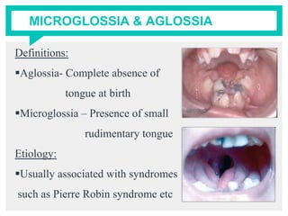 MICROGLOSSIA & AGLOSSIA
Definitions:
Aglossia- Complete absence of
tongue at birth
Microglossia – Presence of small
rudimentary tongue
Etiology:
Usually associated with syndromes
such as Pierre Robin syndrome etc
 