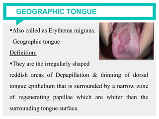 GEOGRAPHIC TONGUE
Also called as Erythema migrans.
Geographic tongue
Definition:
They are the irregularly shaped
reddish areas of Depapillation & thinning of dorsal
tongue epithelium that is surrounded by a narrow zone
of regenerating papillae which are whiter than the
surrounding tongue surface.
 