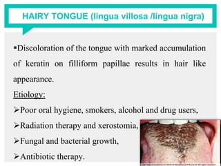 HAIRY TONGUE (lingua villosa /lingua nigra)
Discoloration of the tongue with marked accumulation
of keratin on filliform papillae results in hair like
appearance.
Etiology:
Poor oral hygiene, smokers, alcohol and drug users,
Radiation therapy and xerostomia,
Fungal and bacterial growth,
Antibiotic therapy.
 