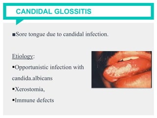 CANDIDAL GLOSSITIS
■Sore tongue due to candidal infection.
Etiology:
Opportunistic infection with
candida.albicans
Xerostomia,
Immune defects
 