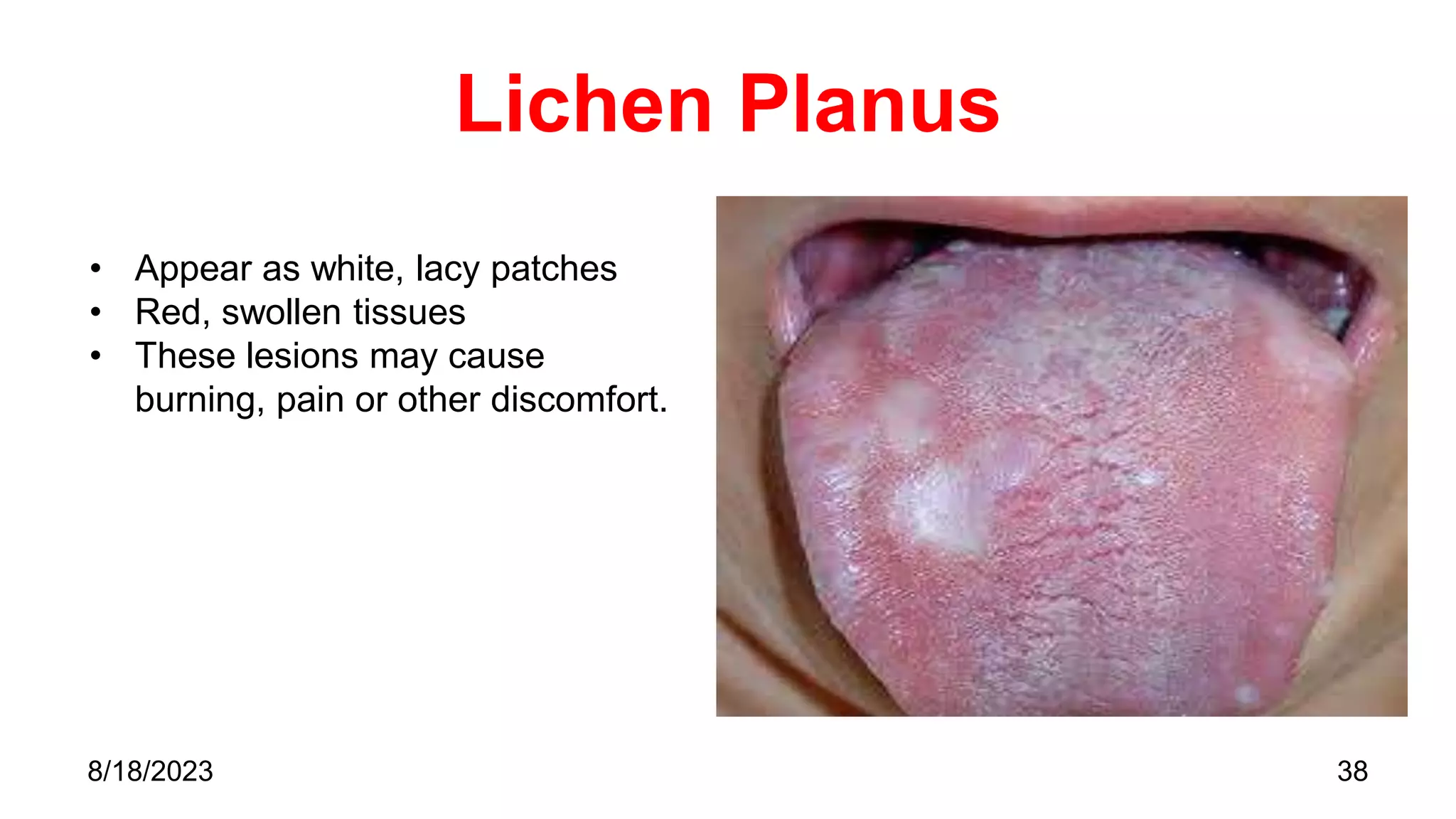Lichen Planus
38
8/18/2023
• Appear as white, lacy patches
• Red, swollen tissues
• These lesions may cause
burning, pain or other discomfort.
 