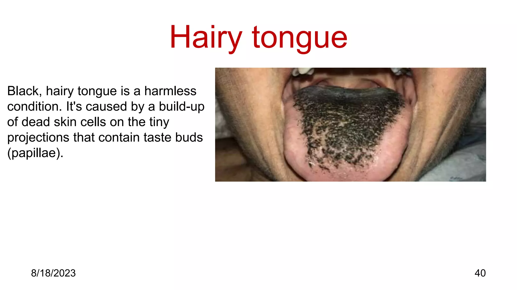 Hairy tongue
40
8/18/2023
Black, hairy tongue is a harmless
condition. It's caused by a build-up
of dead skin cells on the tiny
projections that contain taste buds
(papillae).
 