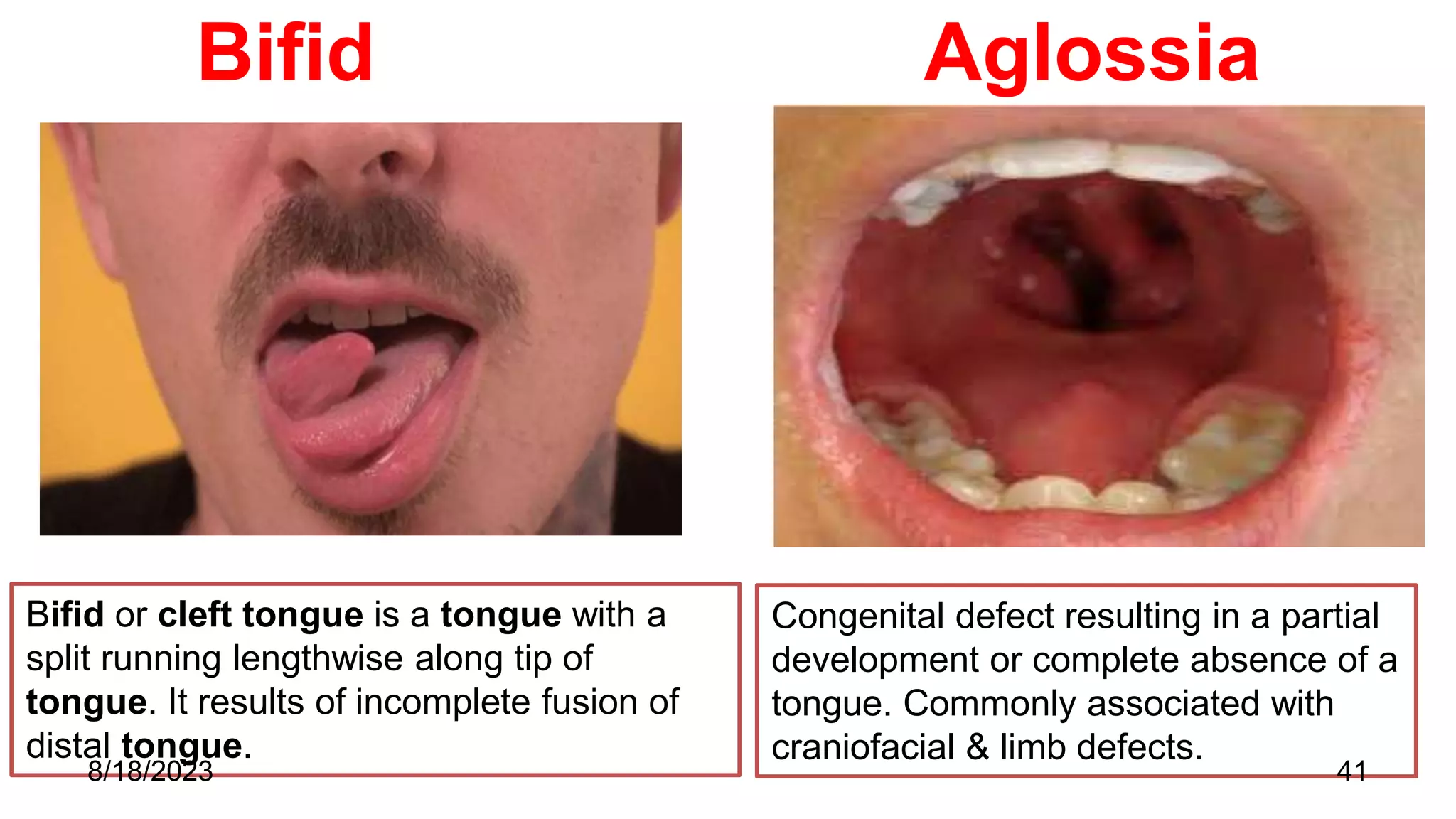 Bifid Aglossia
Bifid or cleft tongue is a tongue with a
split running lengthwise along tip of
tongue. It results of incomplete fusion of
distal tongue.
Congenital defect resulting in a partial
development or complete absence of a
tongue. Commonly associated with
craniofacial & limb defects.
8/18/2023 41
 