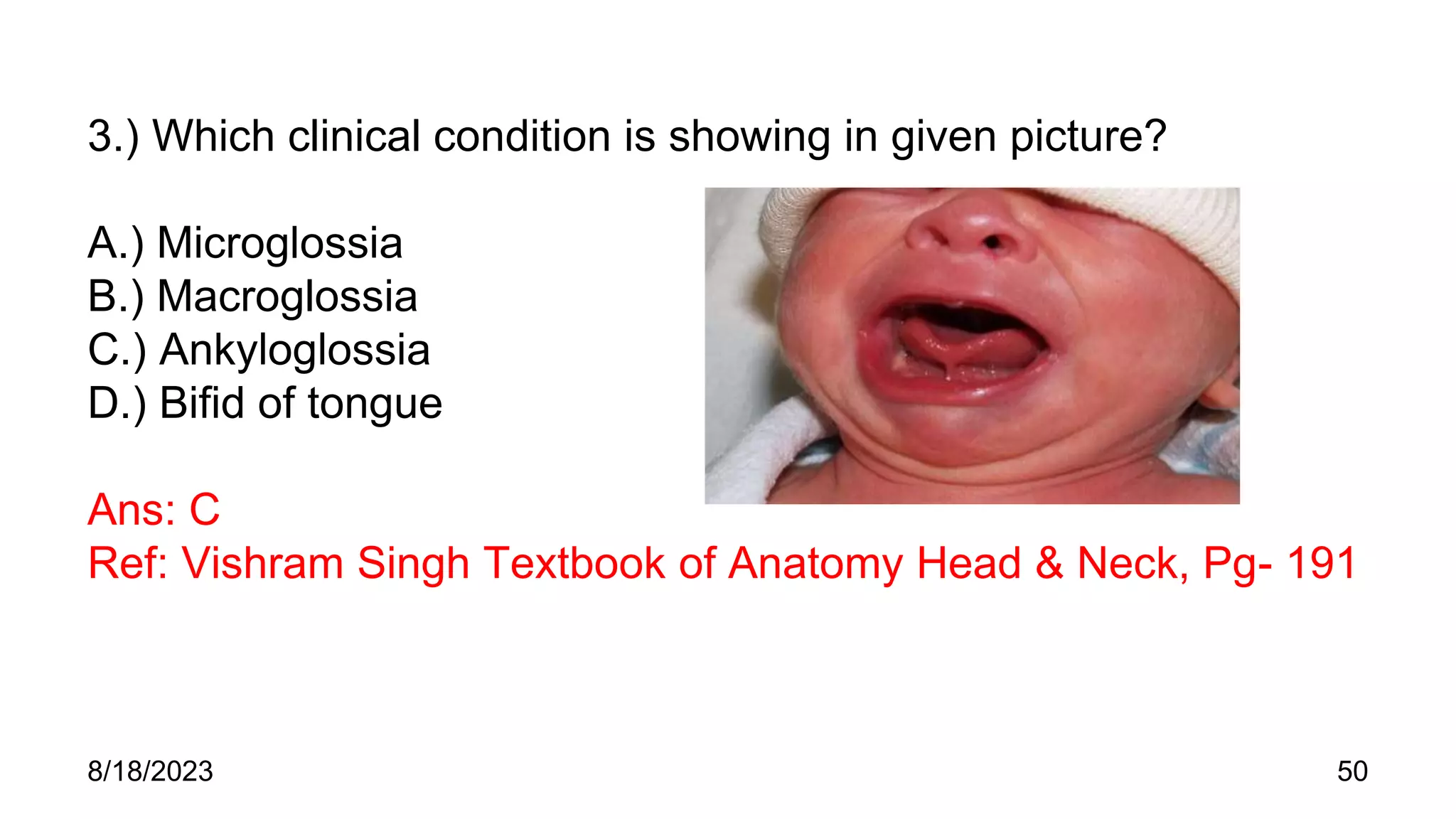 3.) Which clinical condition is showing in given picture?
A.) Microglossia
B.) Macroglossia
C.) Ankyloglossia
D.) Bifid of tongue
Ans: C
Ref: Vishram Singh Textbook of Anatomy Head & Neck, Pg- 191
8/18/2023 50
 