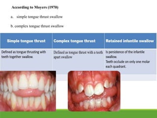 tongue and malocclusion - Copy.pptx