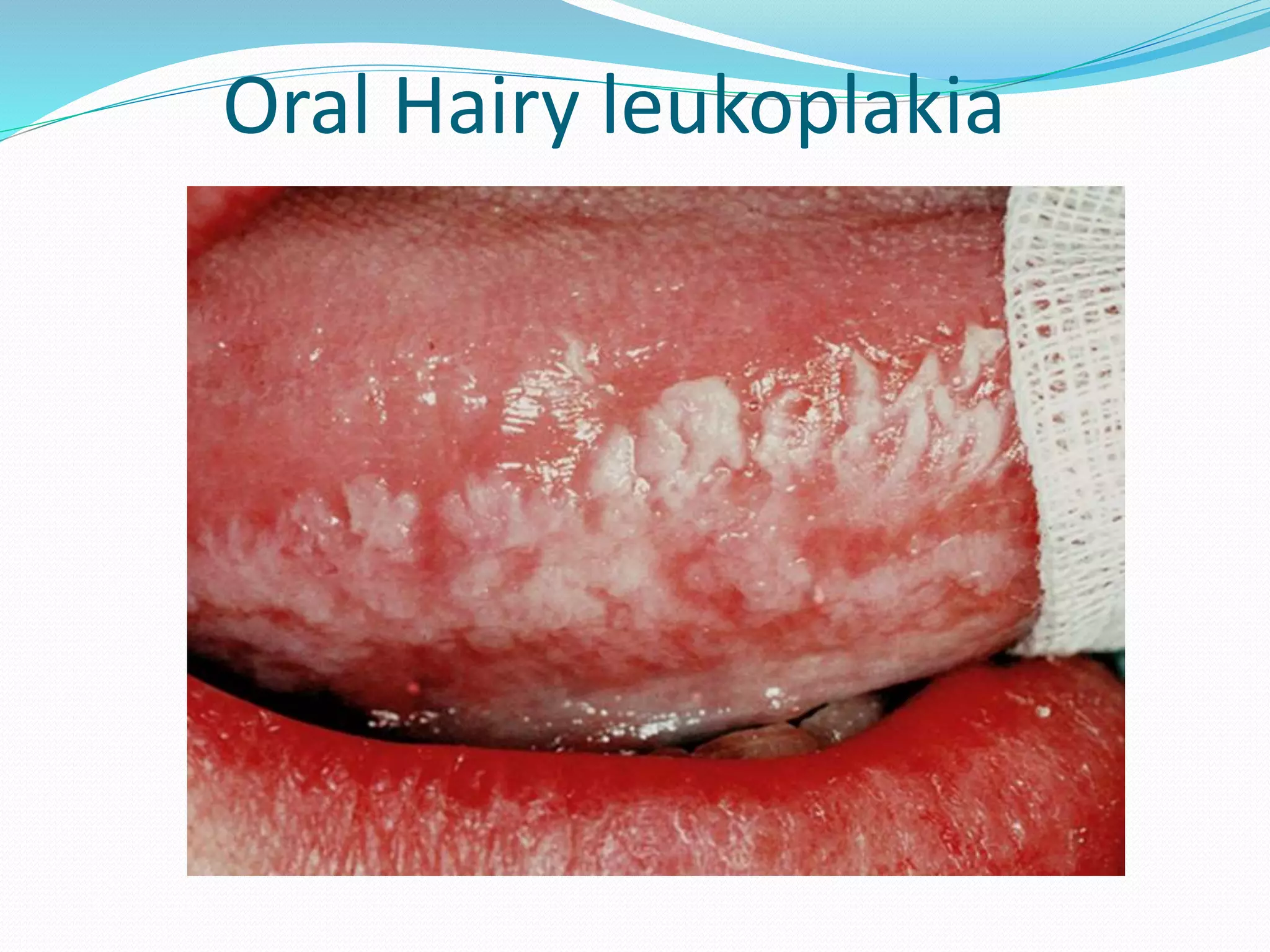 tongue-and-systemic-diseases-pptx