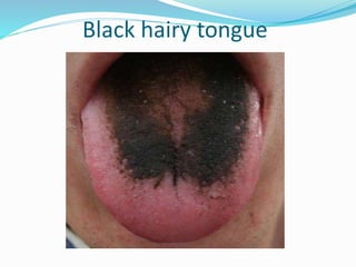 Black hairy tongue
 