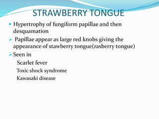 STRAWBERRY TONGUE
 Hypertrophy of fungiform papillae and then
desquamation
 Papillae appear as large red knobs giving the
appearance of stawberry tongue(rasberry tongue)
Seen in
Scarlet fever
Toxic shock syndrome
Kawasaki disease
 