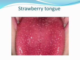 Strawberry tongue
 