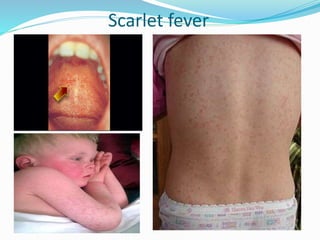Scarlet fever
 