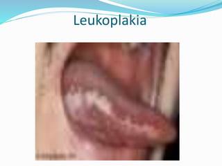 Leukoplakia
 