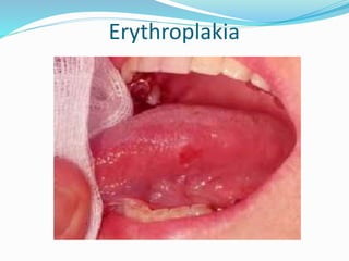 Erythroplakia
 