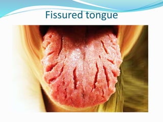 Fissured tongue
 