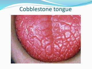 Cobblestone tongue
 
