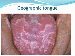 Geographic tongue
 