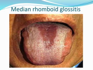 Median rhomboid glossitis
 