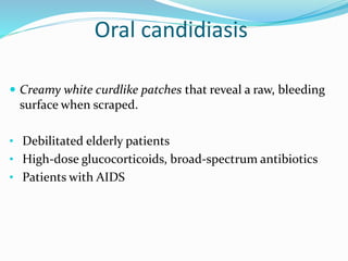 Oral candidiasis
 Creamy white curdlike patches that reveal a raw, bleeding
surface when scraped.
• Debilitated elderly patients
• High-dose glucocorticoids, broad-spectrum antibiotics
• Patients with AIDS
 
