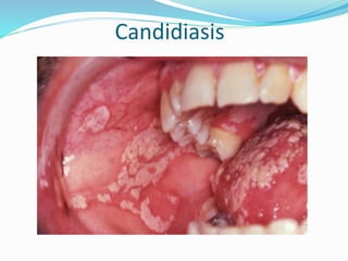 Candidiasis
 