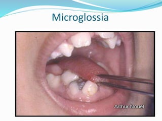 Microglossia
 