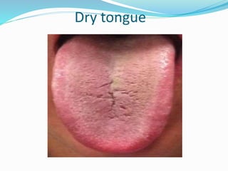 Dry tongue
 