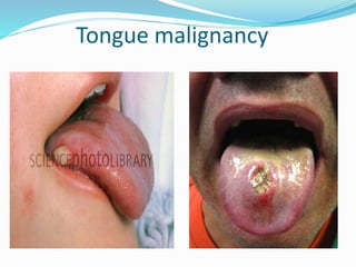 Tongue malignancy
 
