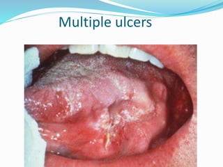 Multiple ulcers
 