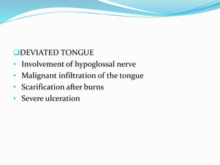 DEVIATED TONGUE
• Involvement of hypoglossal nerve
• Malignant infiltration of the tongue
• Scarification after burns
• Severe ulceration
 