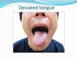 Deviated tongue
 