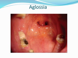 Aglossia
 