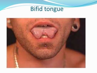 Bifid tongue
 