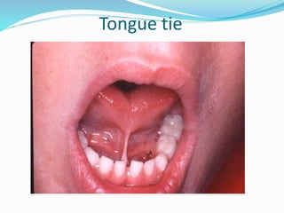 Tongue tie
 