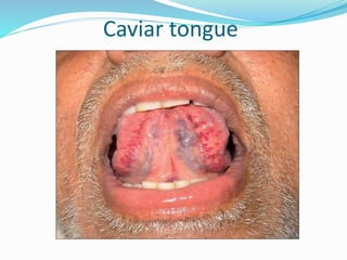 Caviar tongue
 