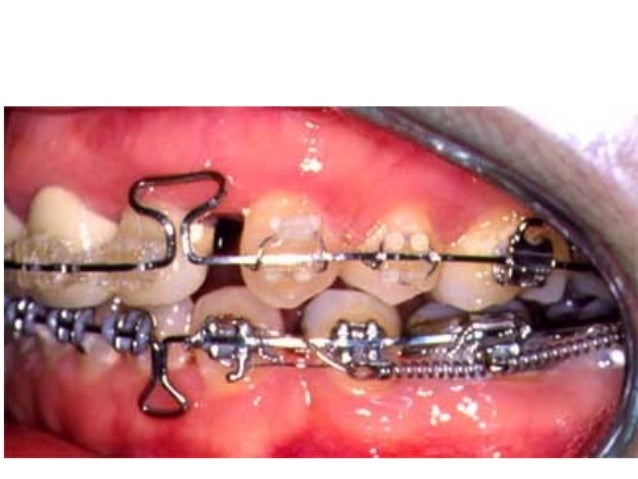 Tongue Crib